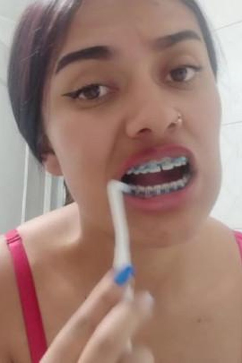 Retainers Fetish - Screenshot 1 of 4 - Brackets