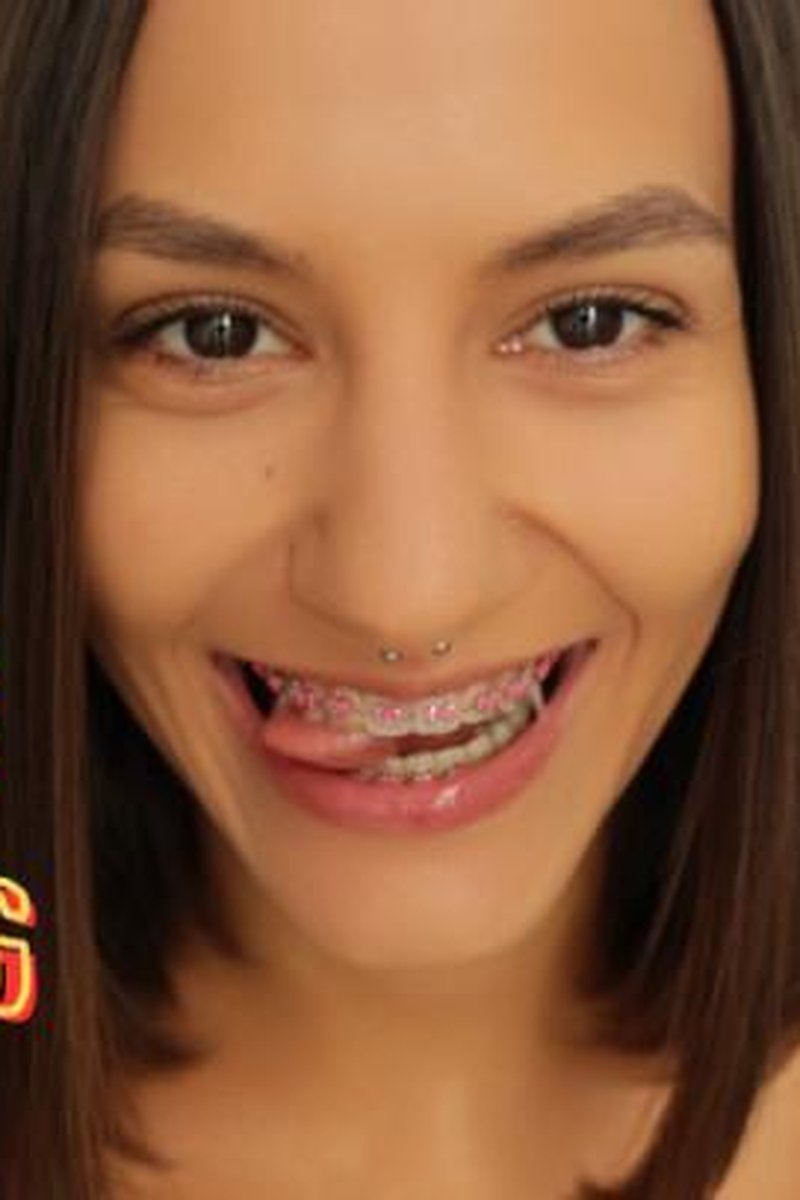 Braces Teasing - Screenshot 1 of 4 - Ahegao