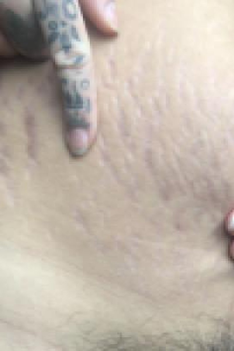 Stretch Marks Postpartum - Screenshot 1 of 4 - Belly Fetish
