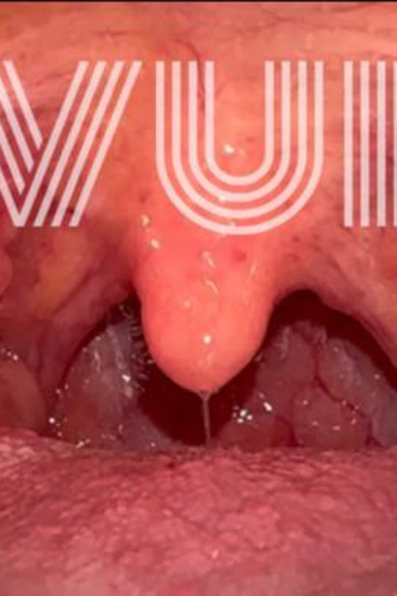 Uvula - Screenshot 1 of 4 - Caries