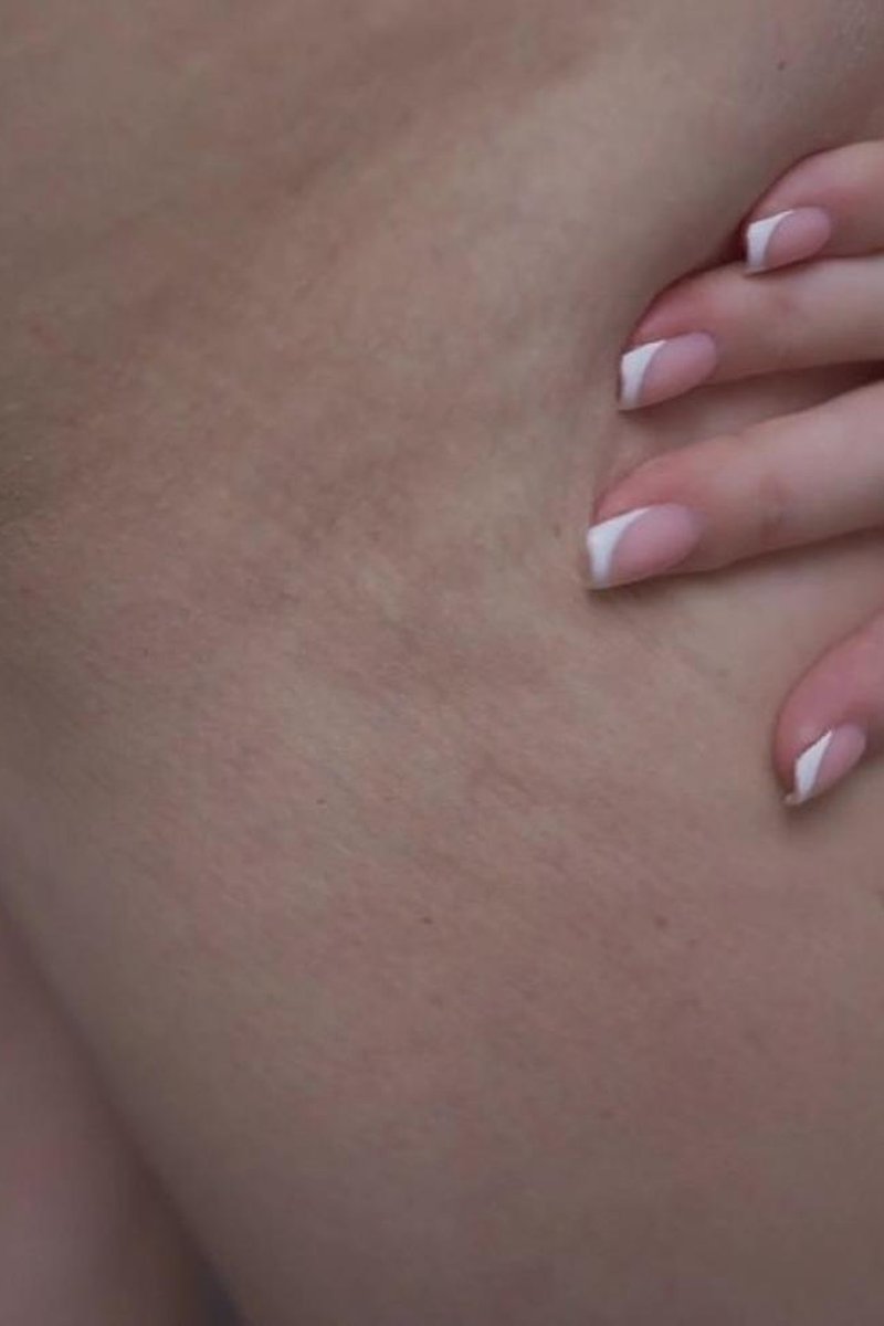 Cellulite Close Up - Screenshot 1 of 4 - Amateur