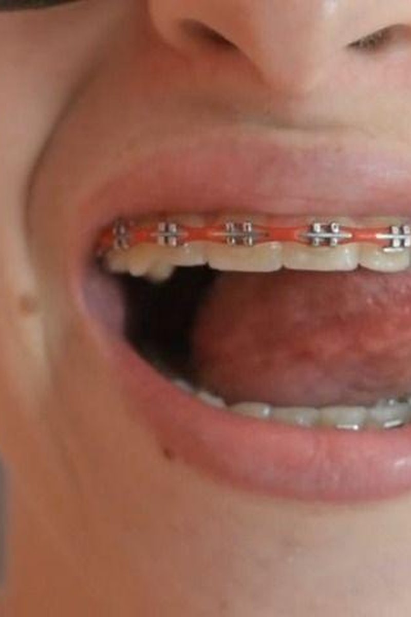 Braces - Screenshot 1 of 4 - Face Fetish