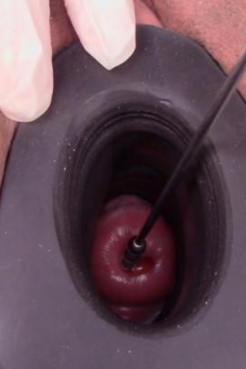 Cervix Sounding Compilation - Screenshot 1 of 4 - Medical Fetish