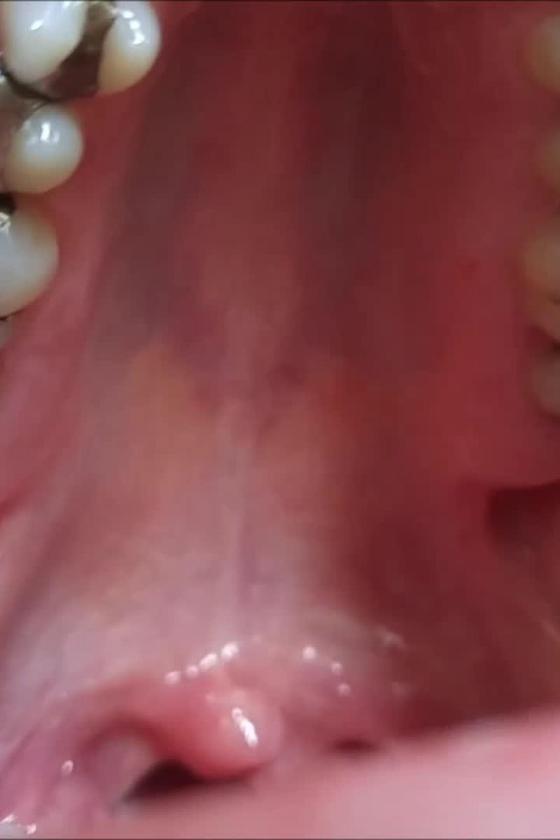 Teeth Update - Screenshot 1 of 4 - Mouth Fetish