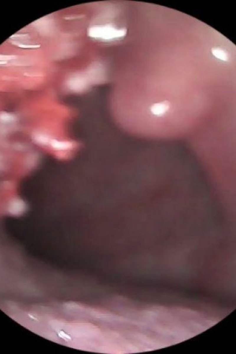 Vore- Endoscope - Screenshot 1 of 4 - Endoscopethroat