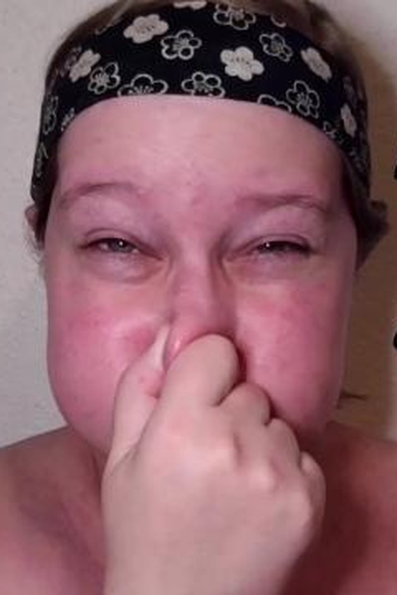 Red Faced Breath Holding And Cheek Puffing - Screenshot 1 of 4 - Asphyxiation