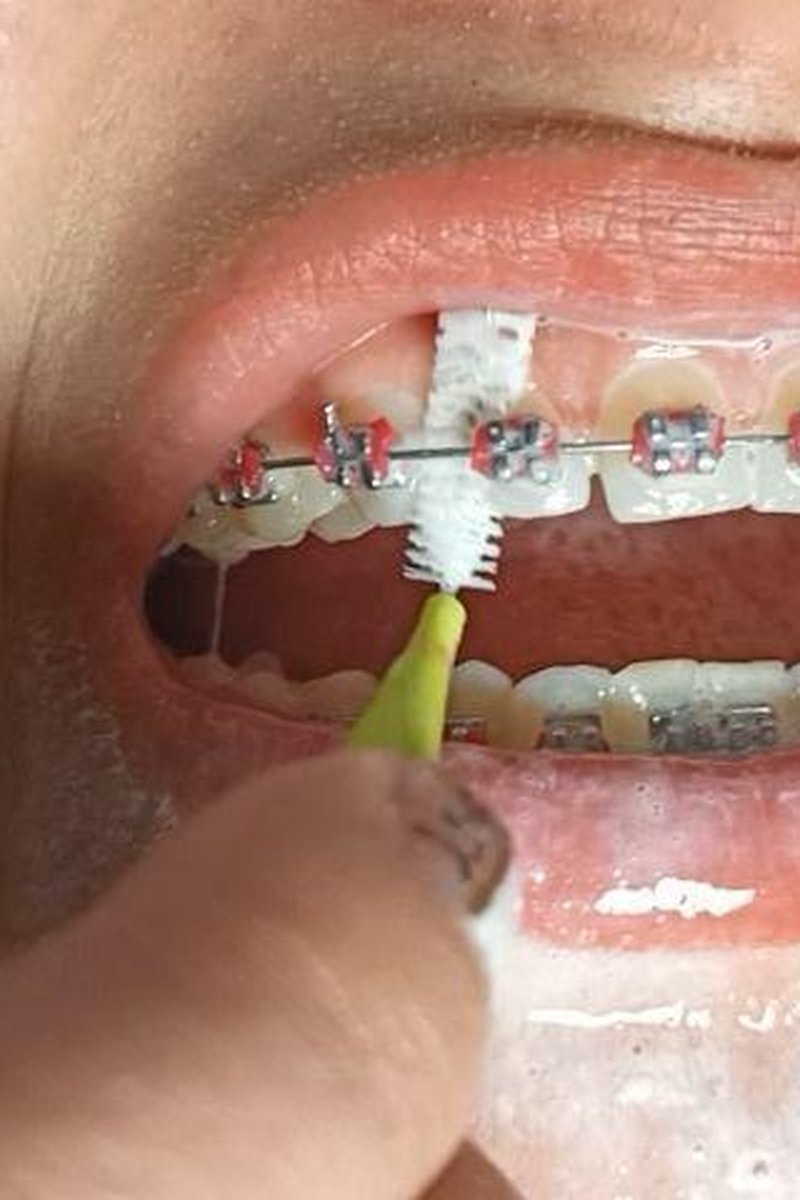 Tooth Brushing ASMR - Screenshot 1 of 4 - Braces