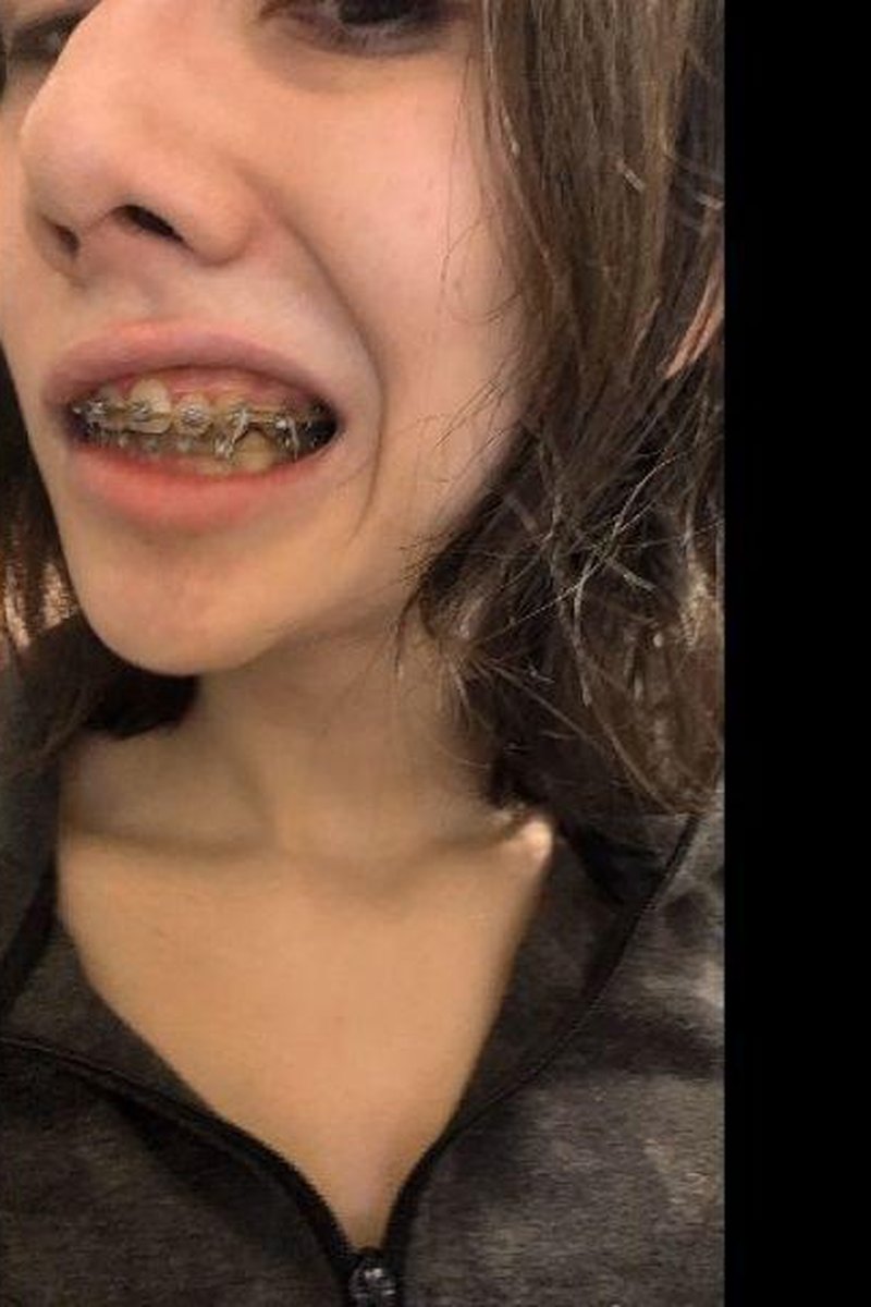 Show Braces - Screenshot 1 of 4 - Babes