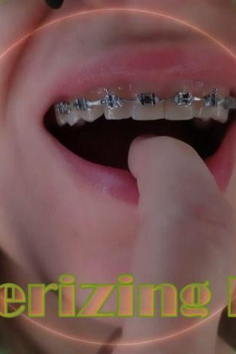 Mesmerizing Braces - Screenshot 1 of 4 - Braces