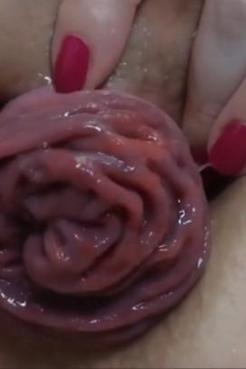 Anal Prolapse - Screenshot 1 of 4 - Anal
