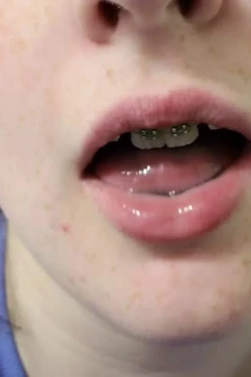 Oral Fixation with Braces + Freckles - Screenshot 1 of 4 - Braces