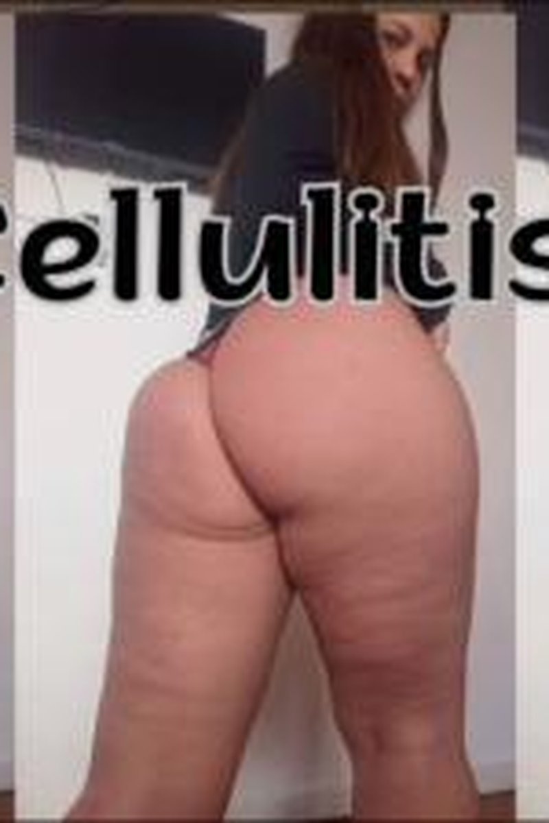 Cellulitis - Screenshot 1 of 4 - BBW