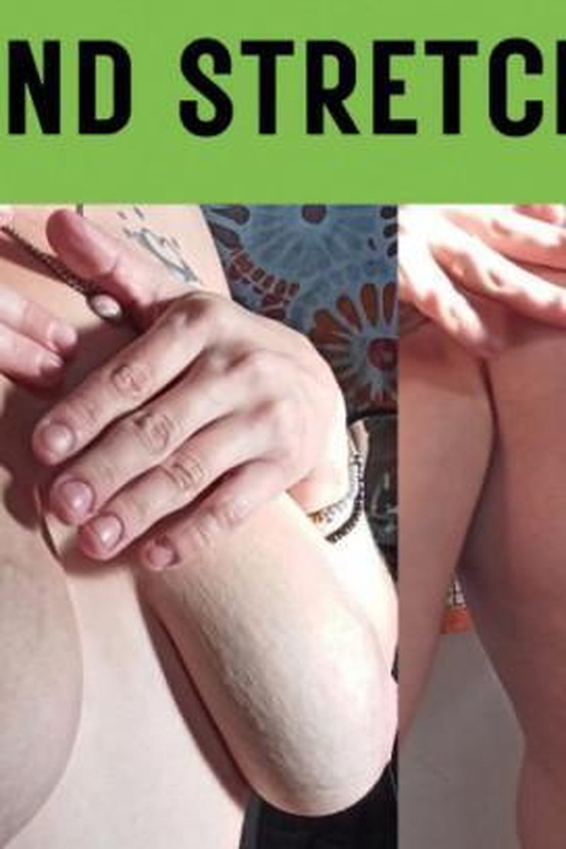 Veins And Too Many Stretch Marks On My Boobs - Screenshot 1 of 4 - Flexible