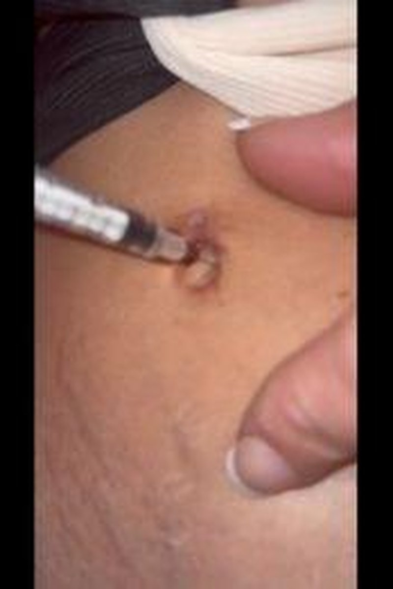 Bellybutton Injection - Screenshot 1 of 4 - Belly Fetish