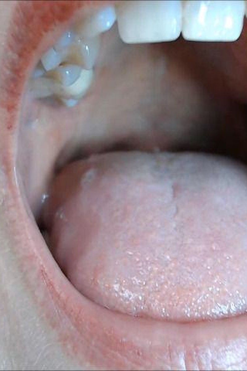 3 Weeks Post Op Tonsils - Screenshot 1 of 4 - BBW