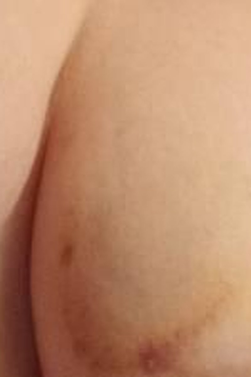 Bruised Breasts - Screenshot 1 of 4 - 20-23 Years Old