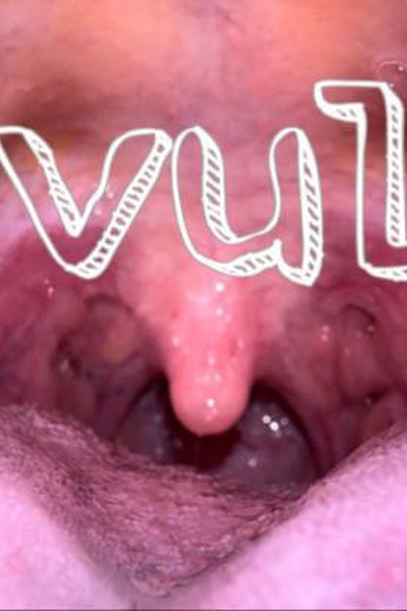 Uvula - Screenshot 1 of 4 - Caries