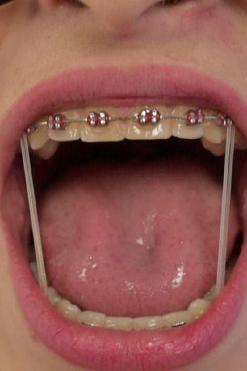 Chewing With Braces - Screenshot 1 of 4 - Braces