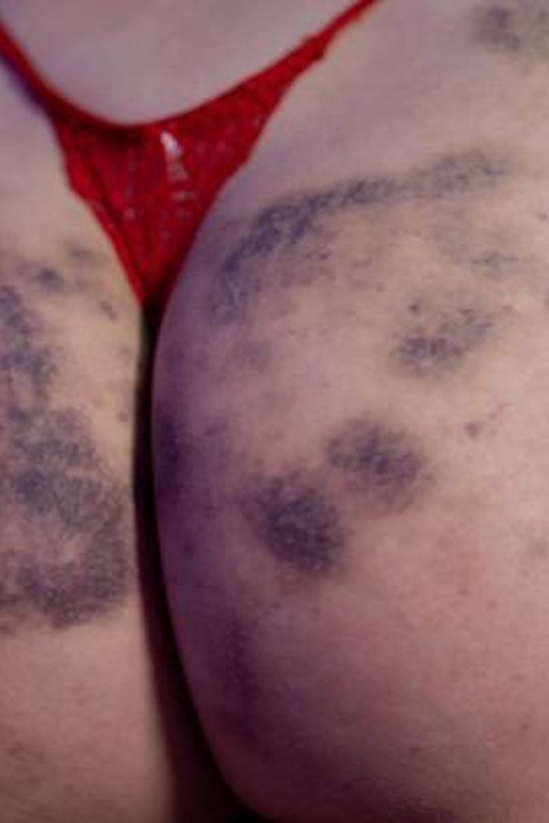 Showing Off My Bruised Body - Screenshot 1 of 4 - BDSM