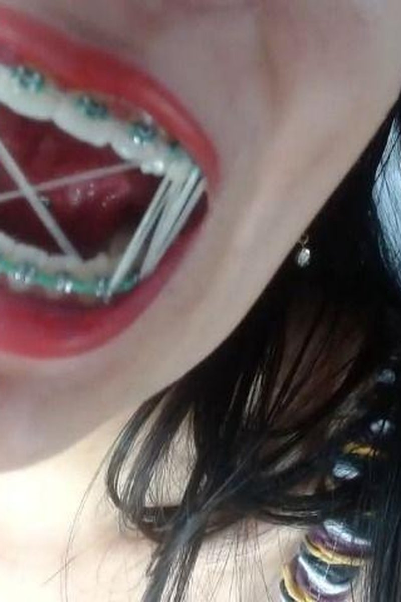 Braces Play - Screenshot 1 of 4 - Braces