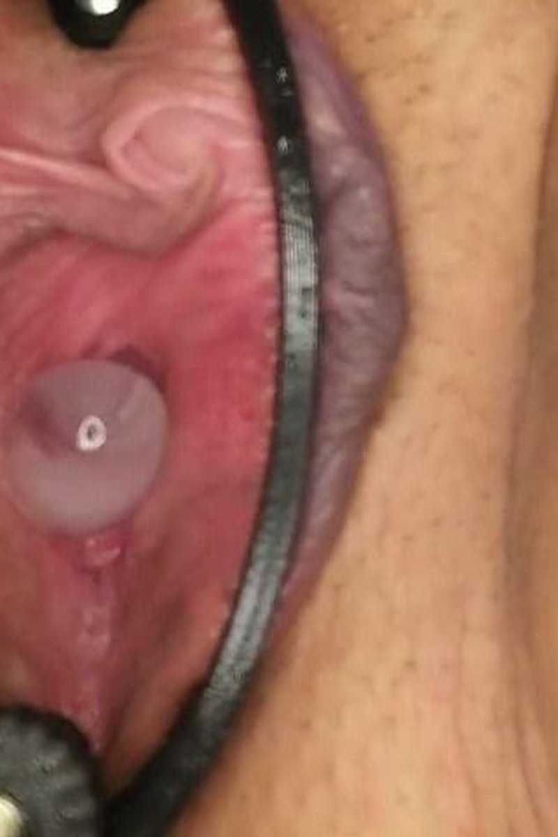 Bladder Endoscopy, Cum Lube, Ice Cubes - Screenshot 1 of 4 - Golden Shower